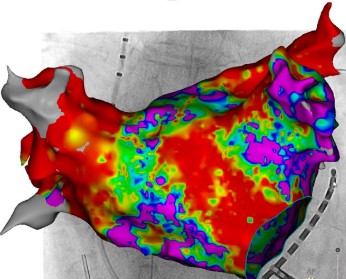 ablationradiofrequence