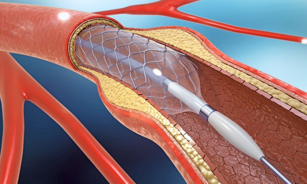 angioplastiecoronaire