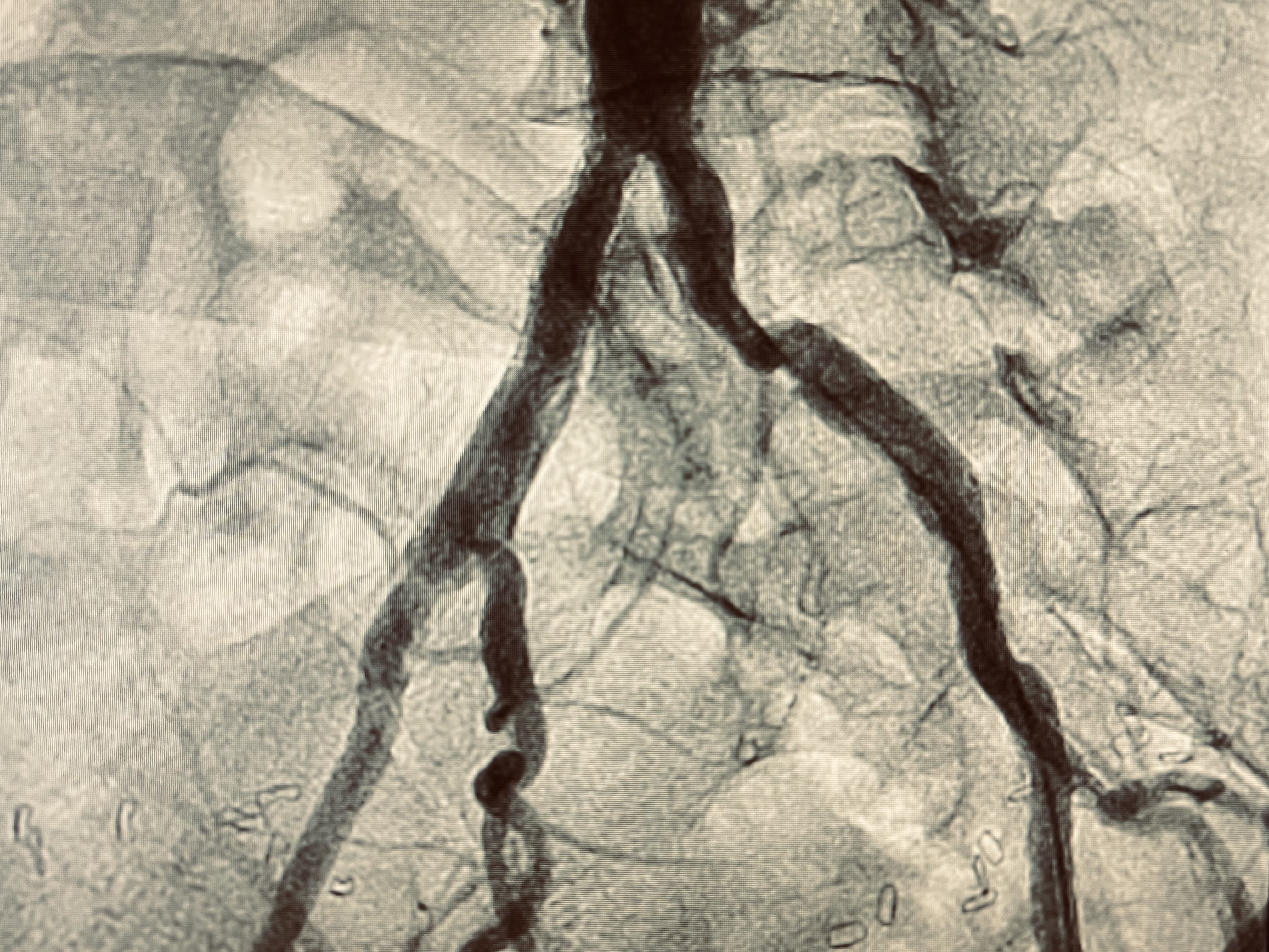 arteriograpghiedesmembresinferieurs