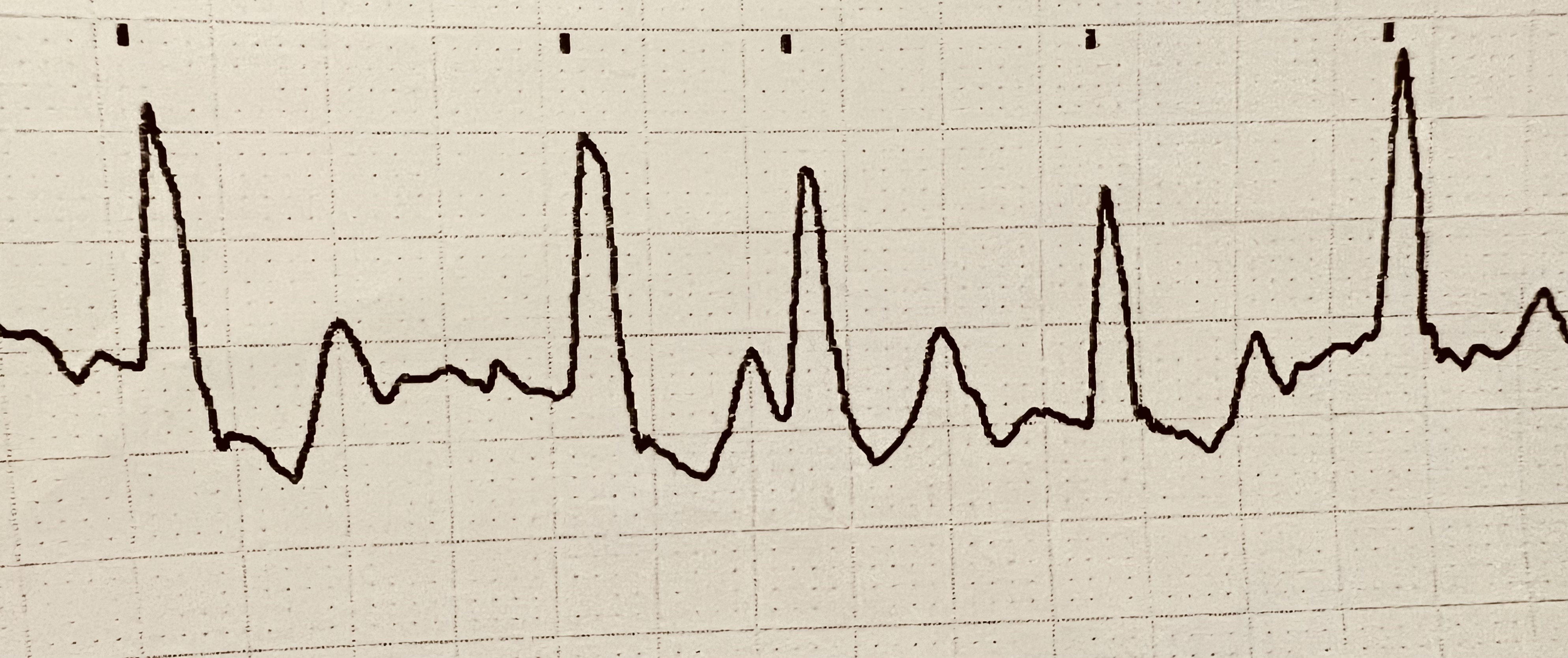 chocelectriquexterne