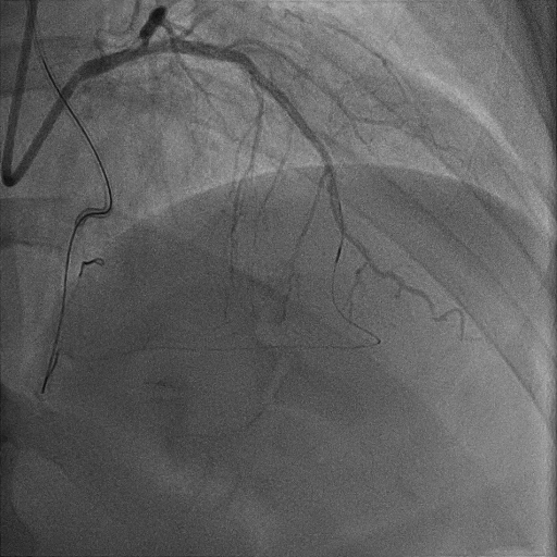 desobstructiondocclusionchronique