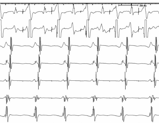 explorationelectrophysiologique
