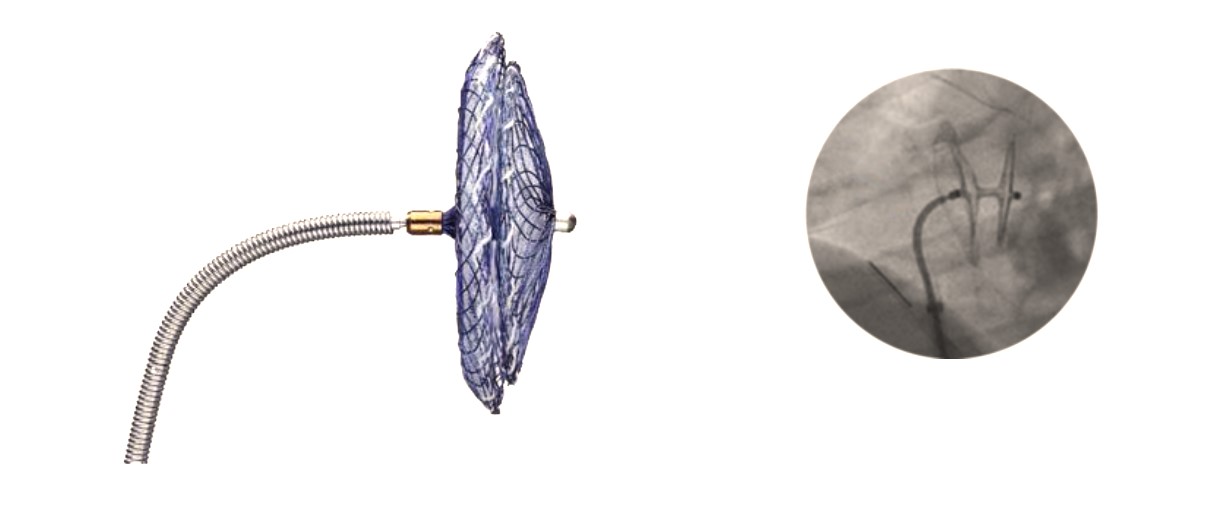 Fermeture de foramen ovale perméable