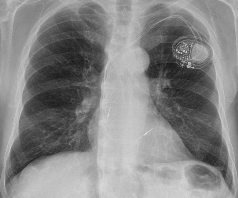 implantationpacemaker