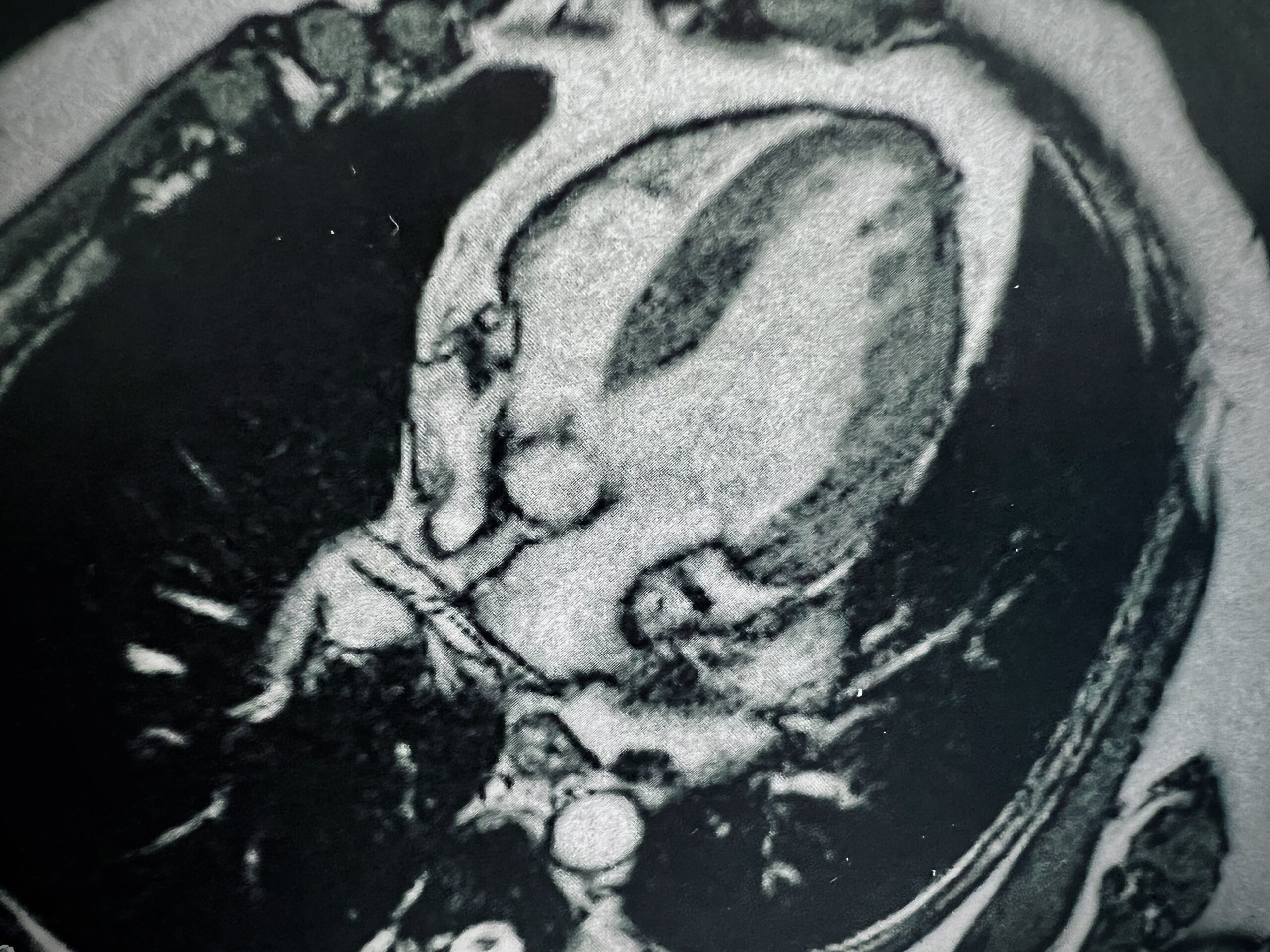 IRM cardiaque