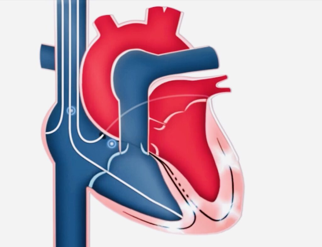 resycnronisationcardiaque
