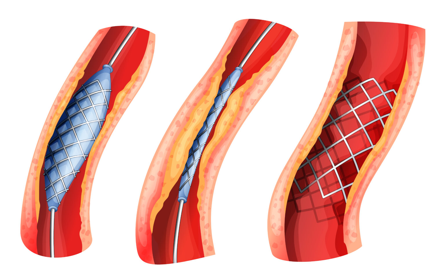 Angioplastie coronaire