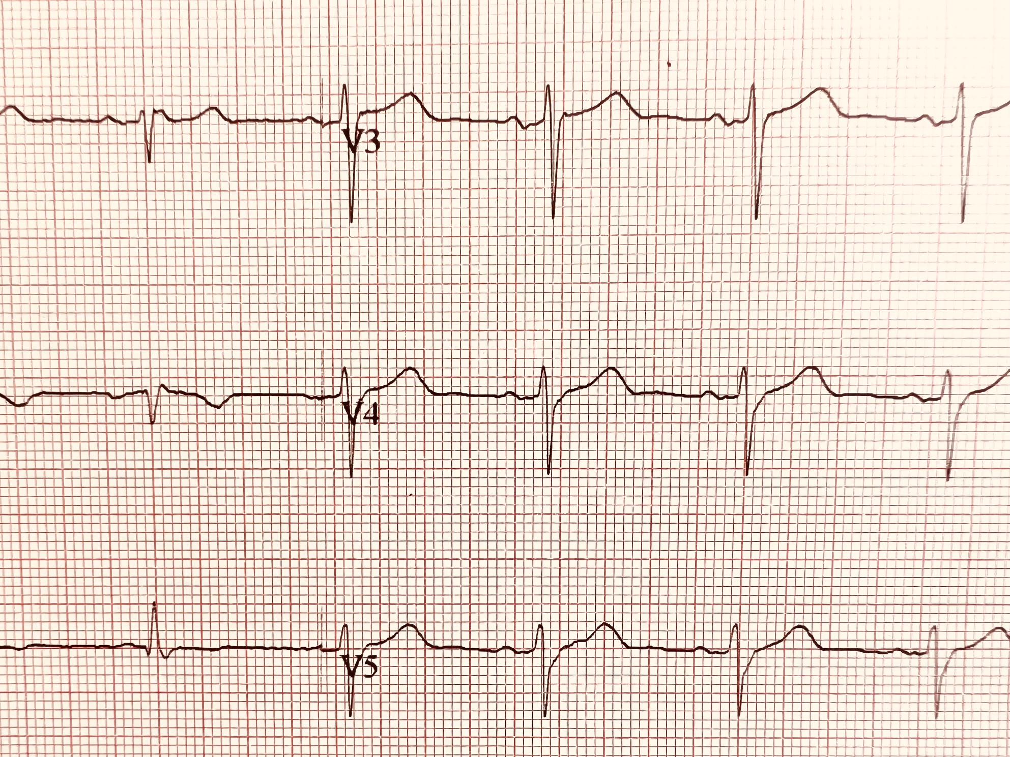 Électrocardiogramme (ECG)