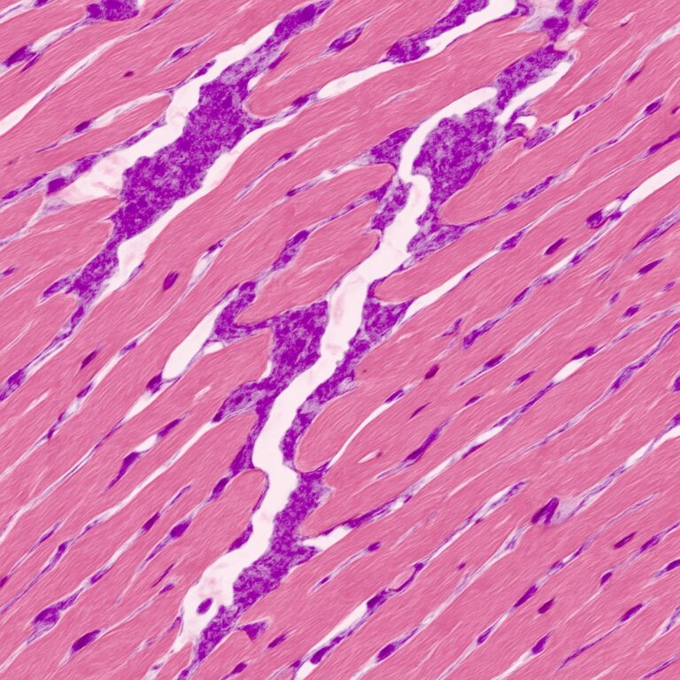 Unité Amylose Cardiaque