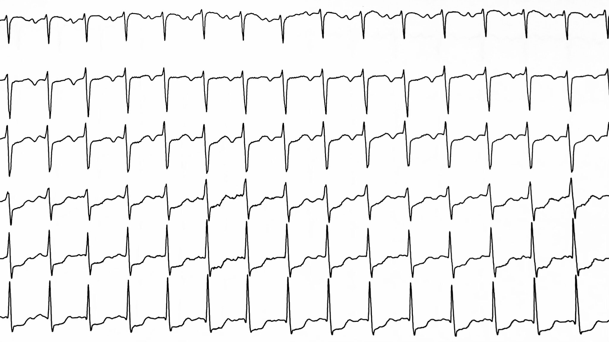 Ablation de tachycardie jonctionnelle