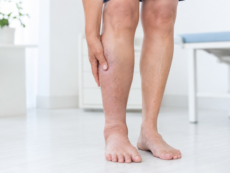 Douleur du mollet évocatrice d'une thrombose veineuse