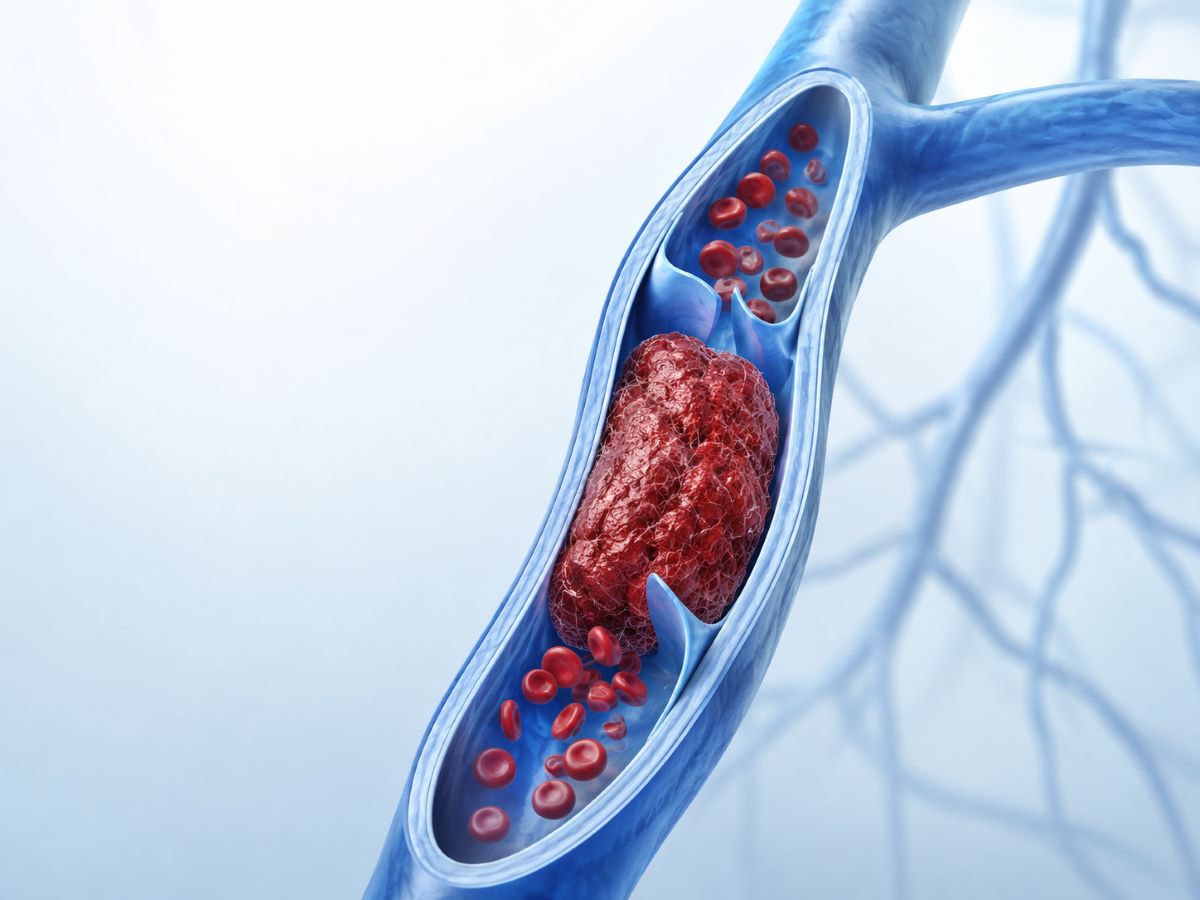 Illustration d'une thrombose veineuse